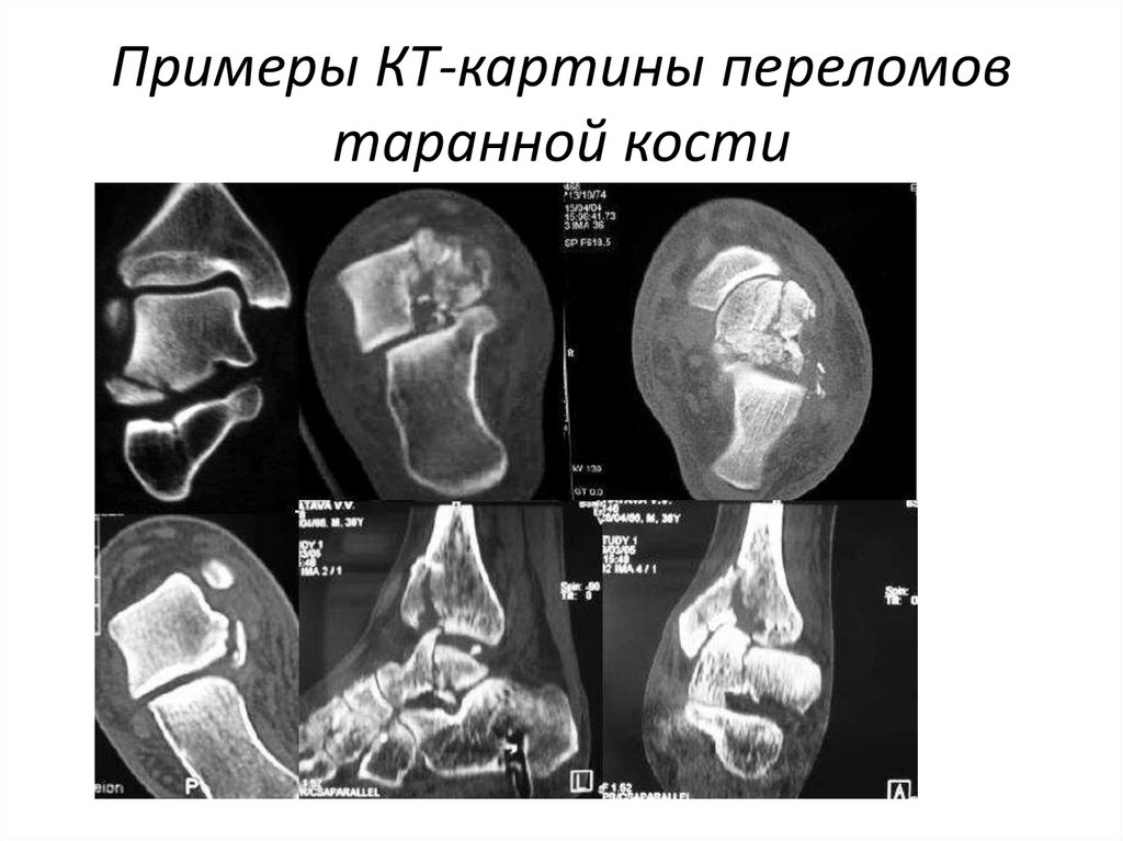 Перелом пяточной кости карта вызова