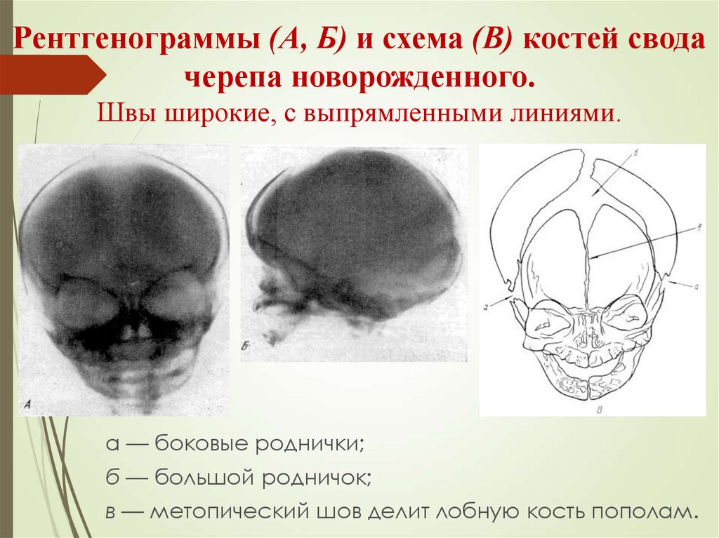 Врожденные аномалии костей черепа нмо ответы