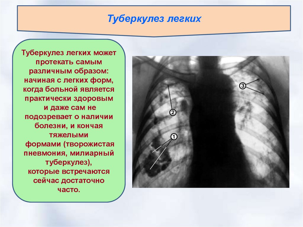 Туберкулез 7 класс. Презентация на тему туберкулез легких.