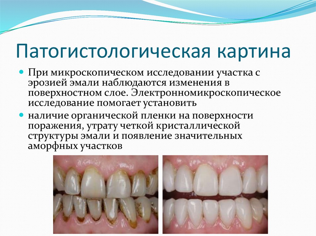 Патогистологическая картина