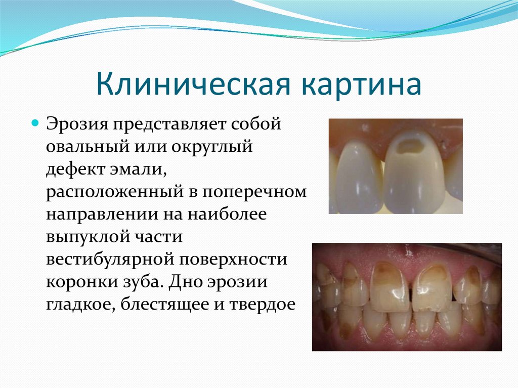 Эрозия зубов - презентация онлайн