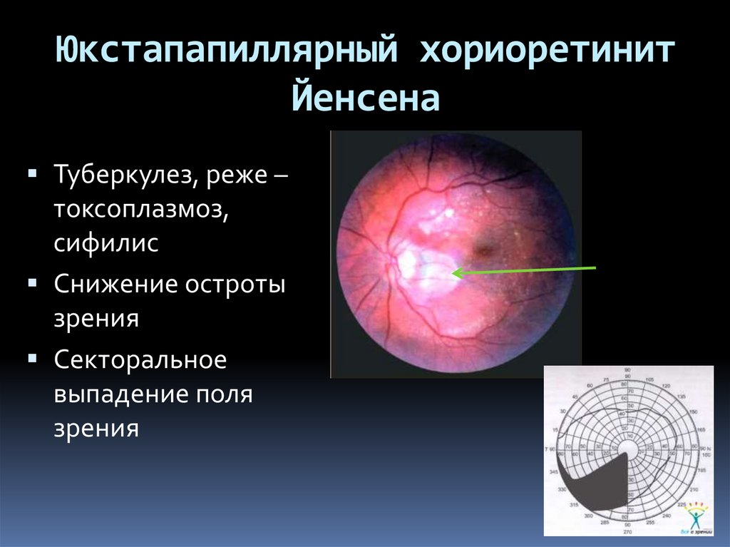 Презентация патология сосудистого тракта