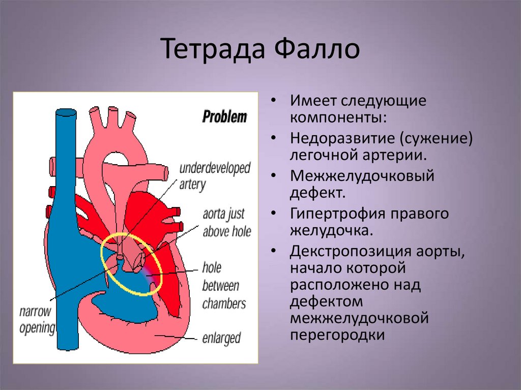 Тетрада фалло