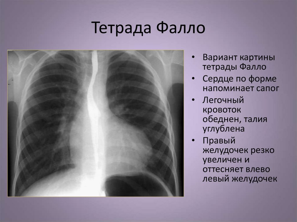 Тетрада фалло презентация