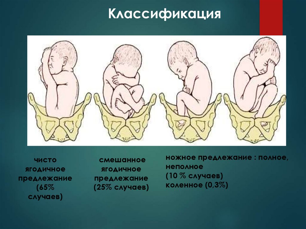 Ножное предлежание плода