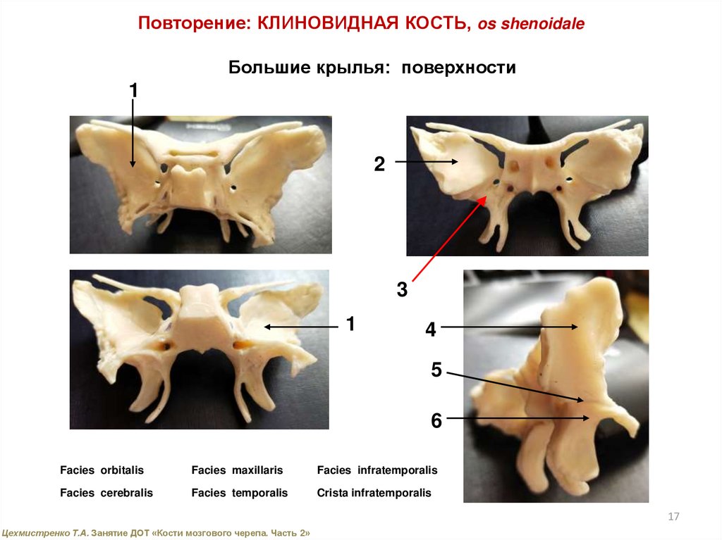 Подвисочный гребень клиновидной кости