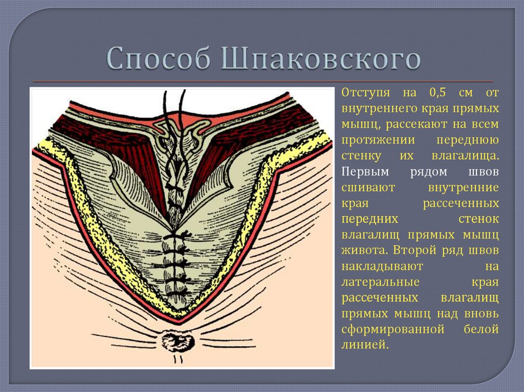 Белая линия живота. Грыжа апоневроза белой линии живота. Грыжа белой линии живота анатомия. Хирургическая анатомия белой линии живота. Строение апоневроза белой линии живота.