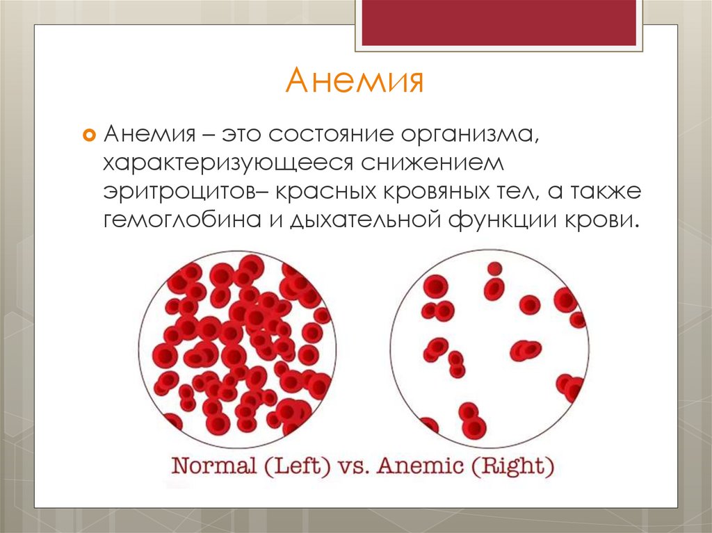 Анемия легкой степени