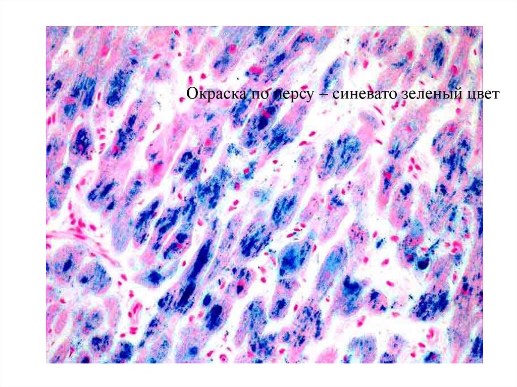 Hemochromatosis of the heart