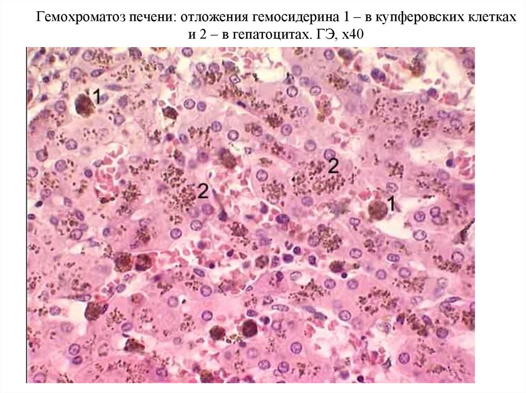 Гемохроматоз печени: отложения гемосидерина 1 – в купферовских клетках и 2 – в гепатоцитах. ГЭ, х40