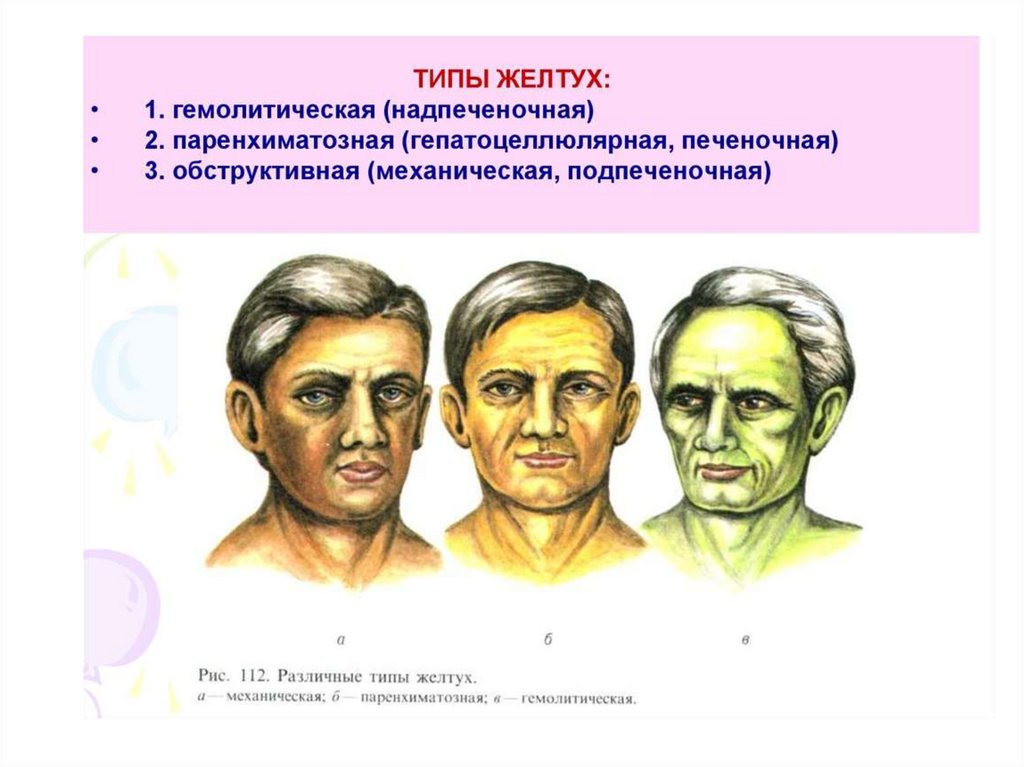 Цвет кожных покровов. Цвет кожи при различных желтухах. При гемолитической желтухе. Гемолитическая желтуха клиника.