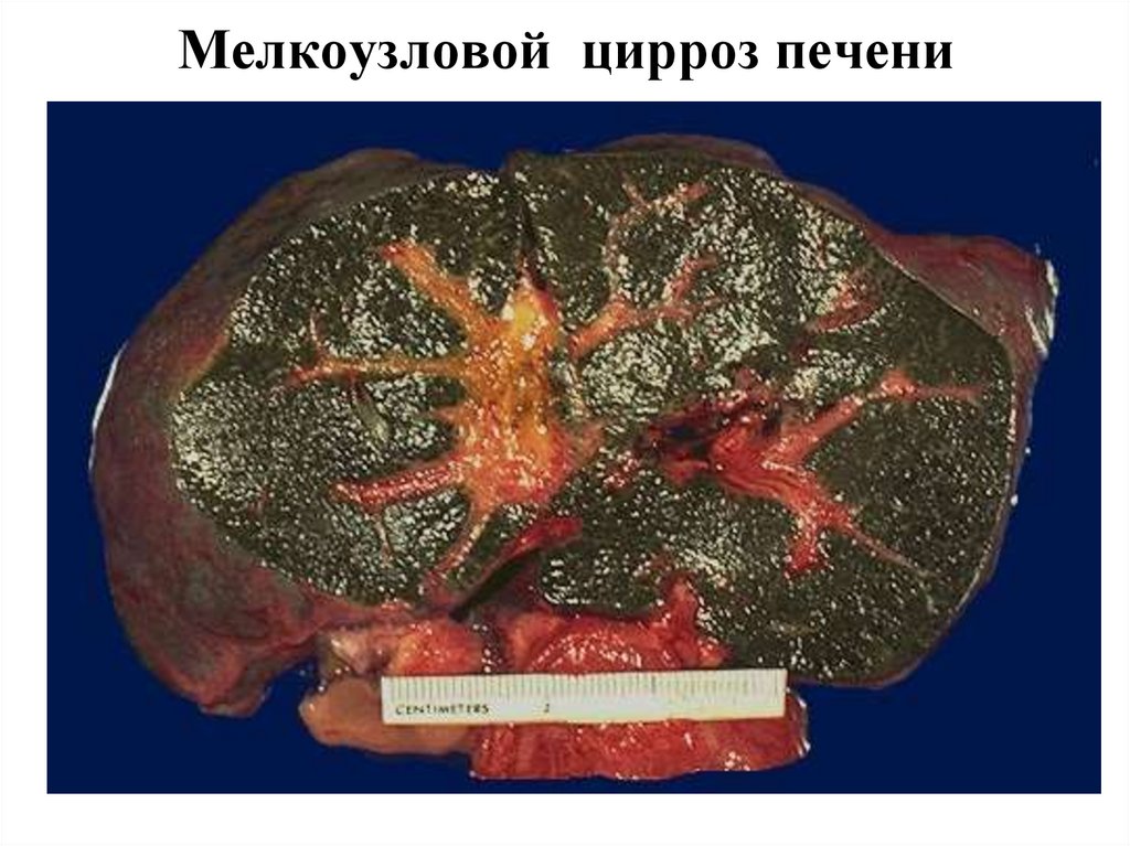Мелкоузловой цирроз печени