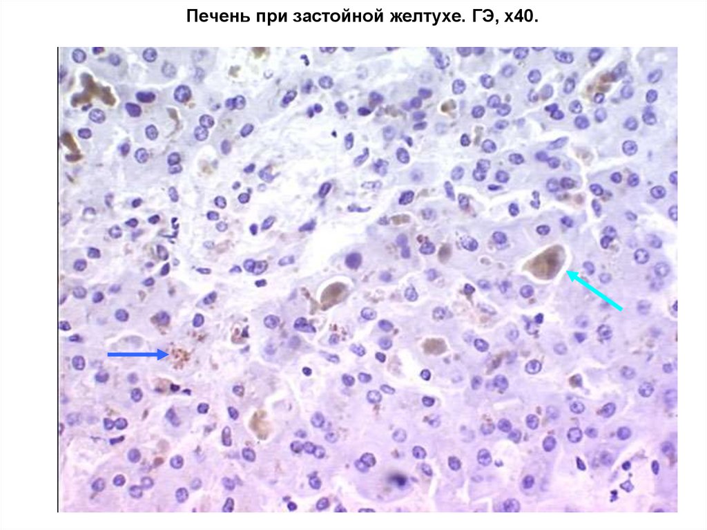 Печень при застойной желтухе. ГЭ, х40.