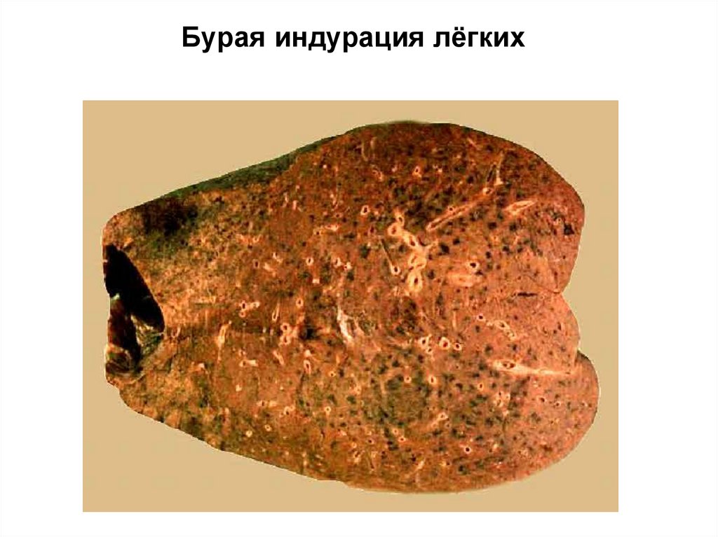 Бурая индурация лёгких