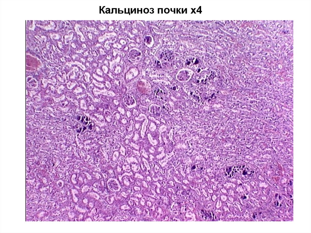 Кальциноз почки х4