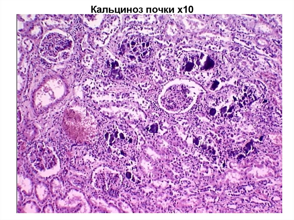 Кальциноз почки х10