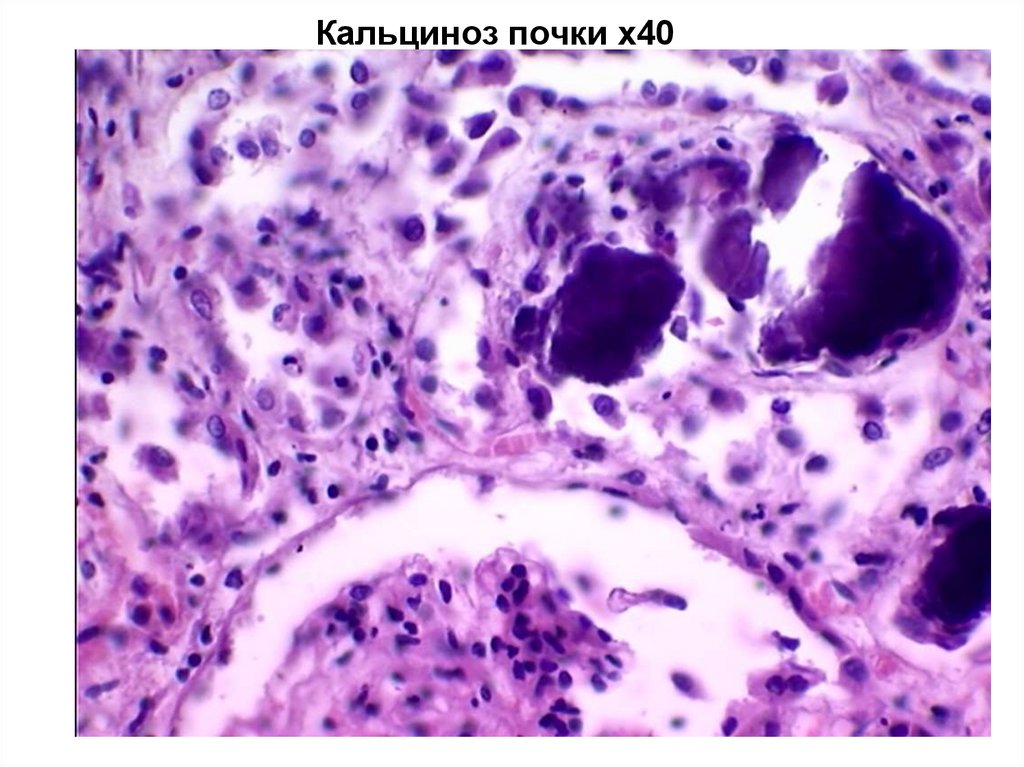 Кальциноз почки х40