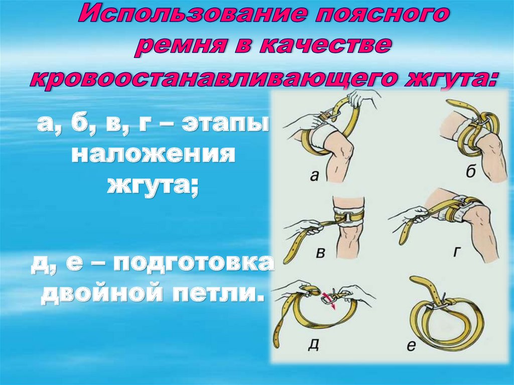 Как определить что кровоостанавливающий жгут наложен правильно