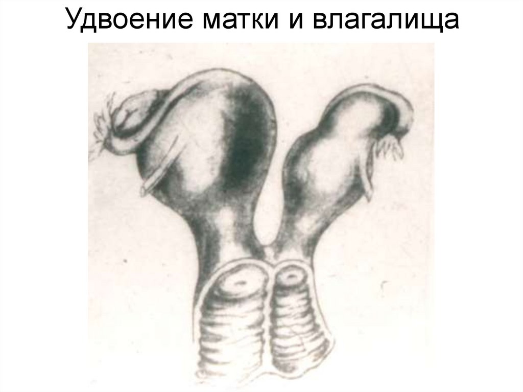 Полная матка. Полное удвоение матки. Полное и неполное удвоение матки. Полное удвоение матки и влагалища.