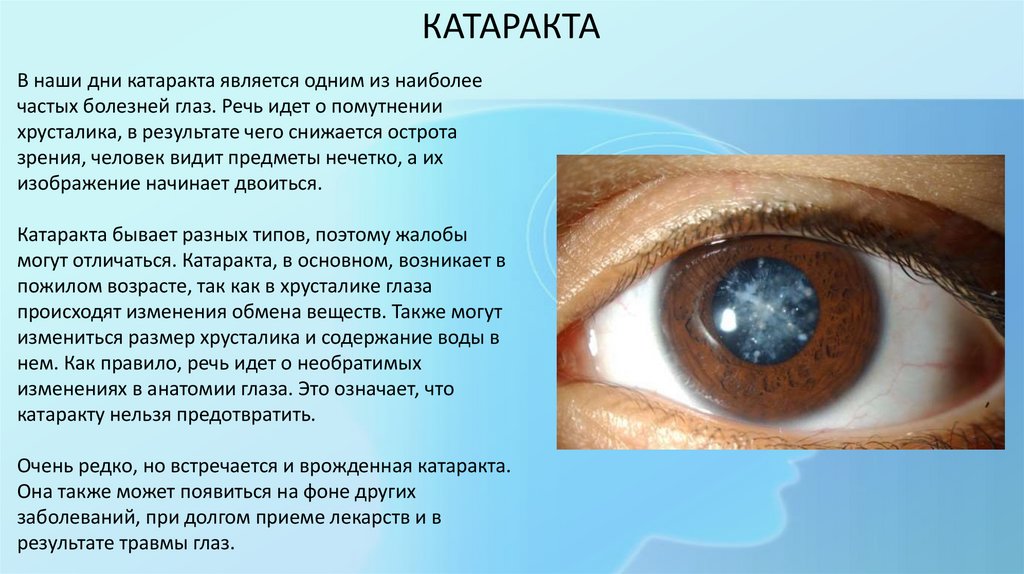 Заболевание и повреждение глаз биология 8 класс. Катаракта глаза таблицы. Заболевание глаз сообщение катаракта. Сообщение на тему глазные болезни. Сообщение на тему заболевание глаз катаракта.
