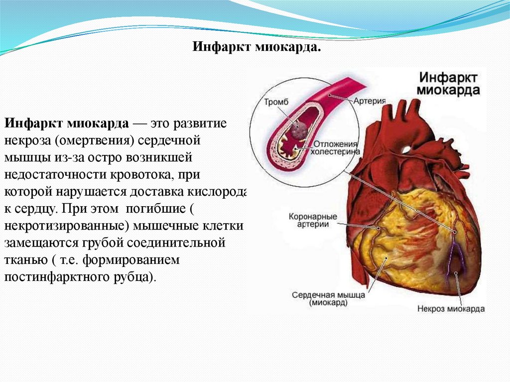 Оим это. Причины развития острого инфаркта миокарда. Форма очага некроза при остром инфаркте миокарда. Острая сердечная недостаточность инфаркт миокарда. Инфаркт миокарда некроз.