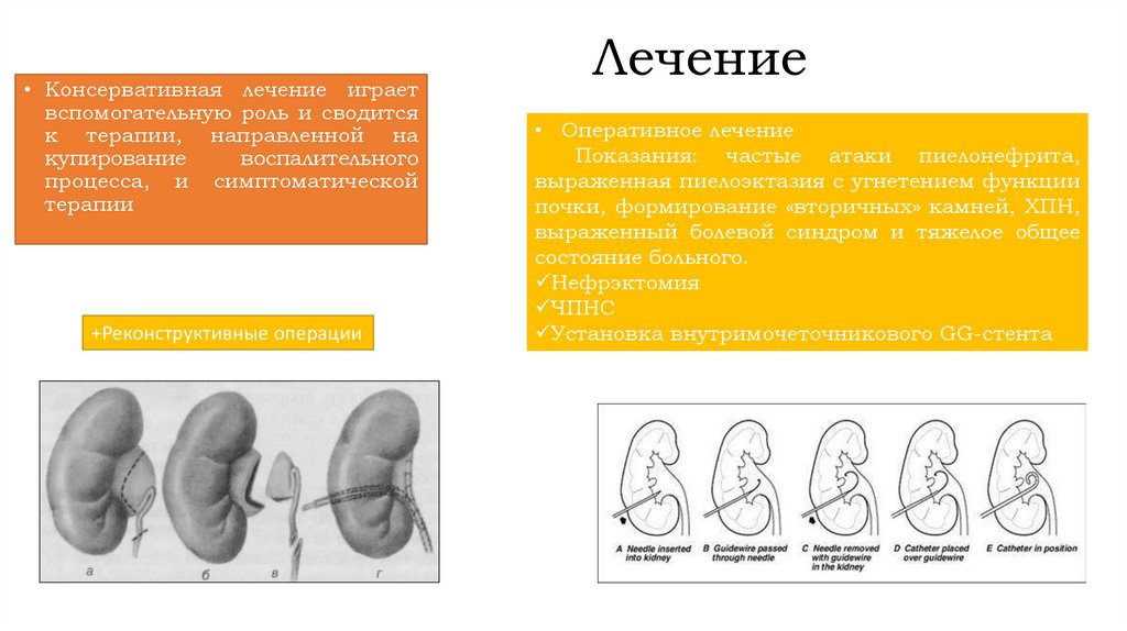 Гидронефроз у детей презентация