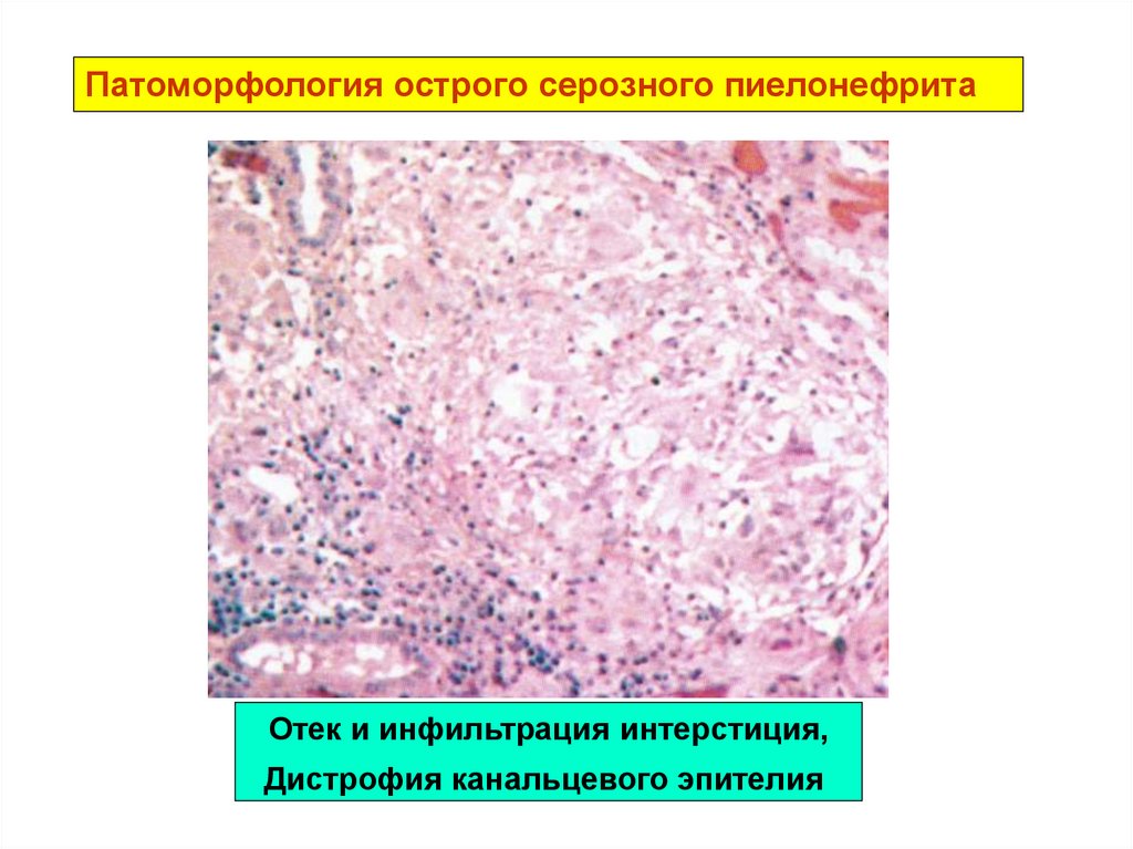 Хронический пиелонефрит микроскопическая картина