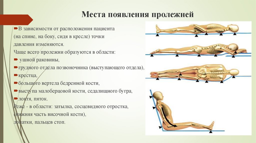 Места образования пролежней картинки