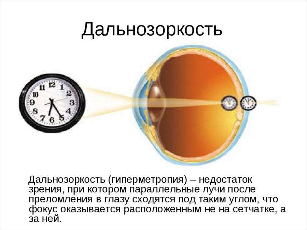 Плюсы плохого зрения. Зрение минус это близорукость или дальнозоркость. Дальнозоркость это плюс или минус. Зрение дальнозоркость плюс или минус. Дефекты зрения дальнозоркость.