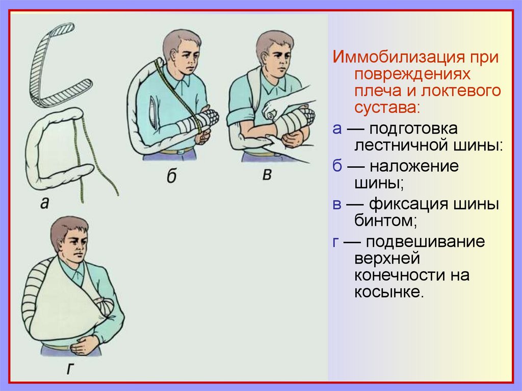 Первое вывихивающее движение при удалении. Первая помощь при переломах и вывихах. Потребности пациента при. Вывихе. Профилактика осложнений переломов и вывихов при эвакуации. Догосдогоспитальная помощь при вывихах.