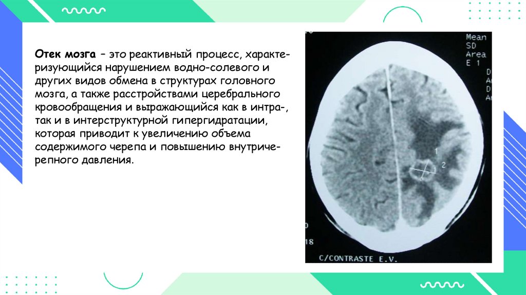 Отек набухание головного мозга. Перифокальный отек головного мозга. Отек-набухание головного мозга при инфекционных заболеваниях. Отек головного мозга g93.6 что это.