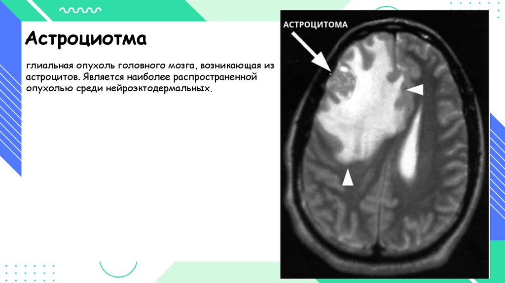 Отек набухание головного мозга.