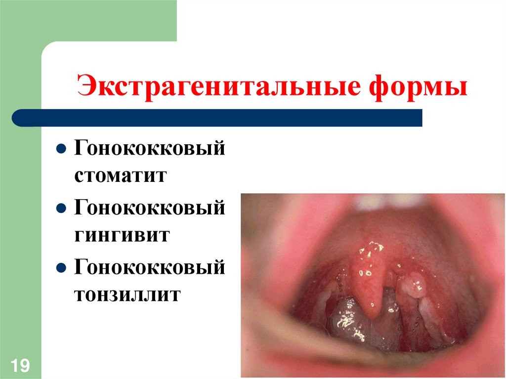 Экстрагенитальные формы