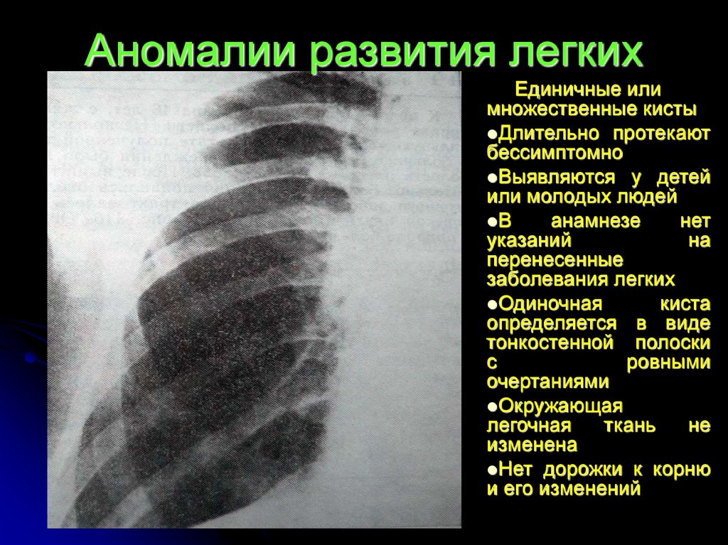 Пороки развития легких презентация