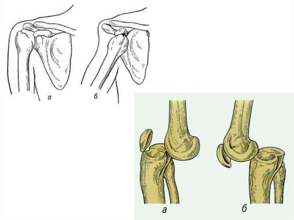 Вывих сустава закрытый перелом разрыв сухожилия. Гипермобильность локтевого сустава.