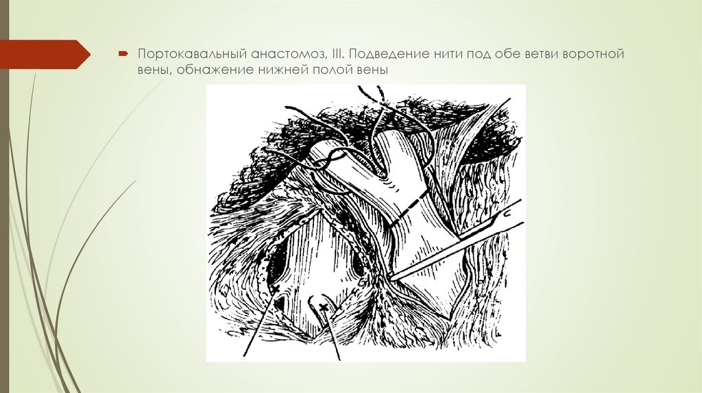 Портокавальные анастомозы презентация