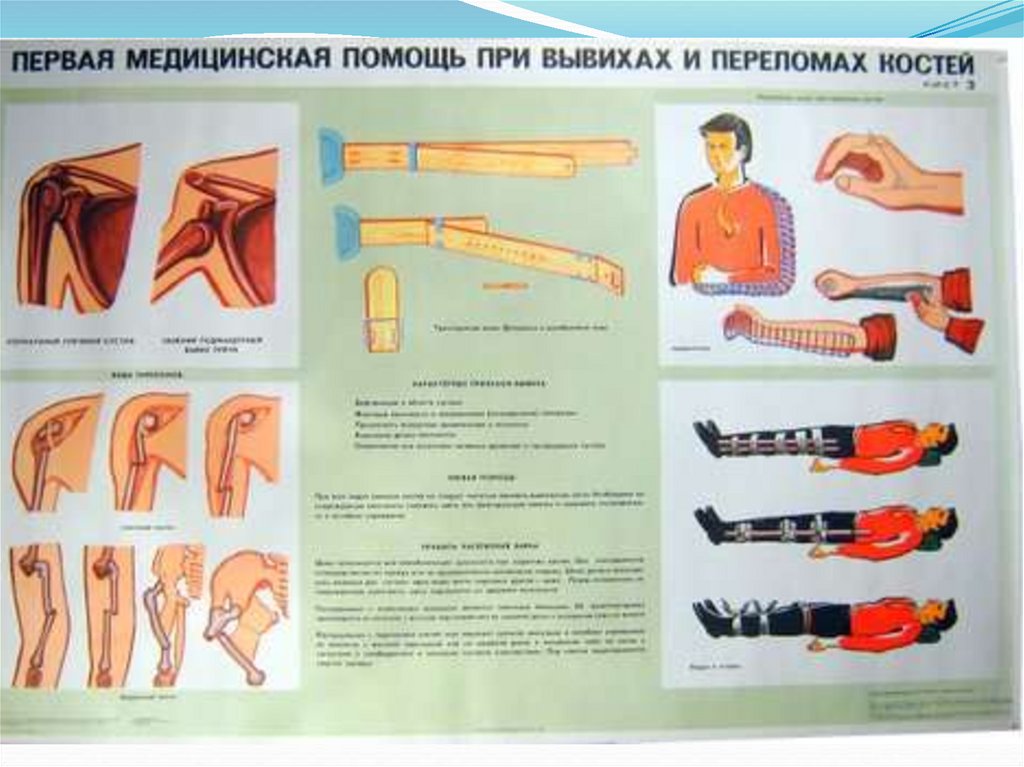 Первое оказание помощи при переломах. ПМП при переломах и вывихах. Оказание первой помощи при переломах вывихах ушибах. ПМП при переломах вывихах растяжениях. Оказание первой помощи при переломах костей , вывихах ушибах ранениях.