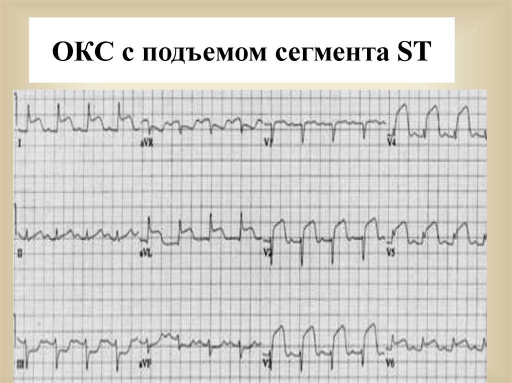 Окс st. Острый коронарный синдром с подъемом сегмента St. Подъем сегмента St. Окс с подъемом сегмента St. ИБС острый коронарный синдром с подъемом сегмента St.