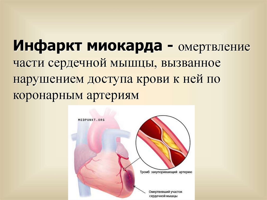 Инфаркт миокарда омертвление.