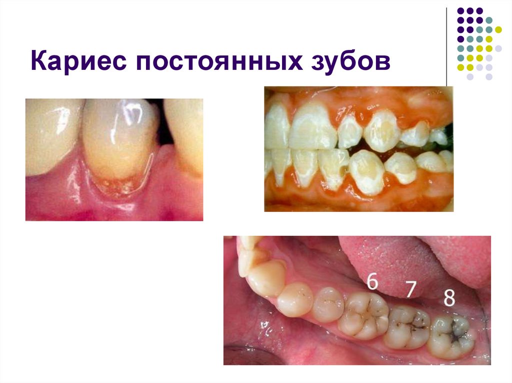 Кариес постоянных зубов