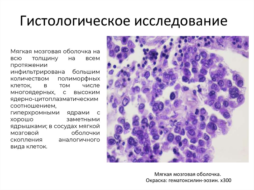 Трофобластическая болезнь гинекология. Мягкая мозговая оболочка гистология. Трофобластическая болезнь картинки. Разрыв мягкой мозговой оболочки.