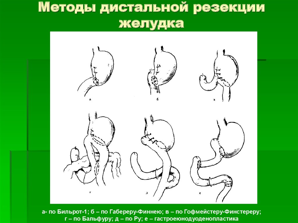 Резекция желудка. По ру операция Бильрот 1 Бильрот 2. Бильрот в модификации гофмейстера. Бильрот 1 в модификации гофмейстера-Финстерера. Бильрот 2 в модификации Бальфура.