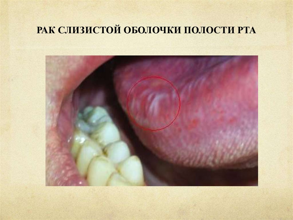 Рак полости рта: вовремя распознать и вылечить! - презентация онлайн