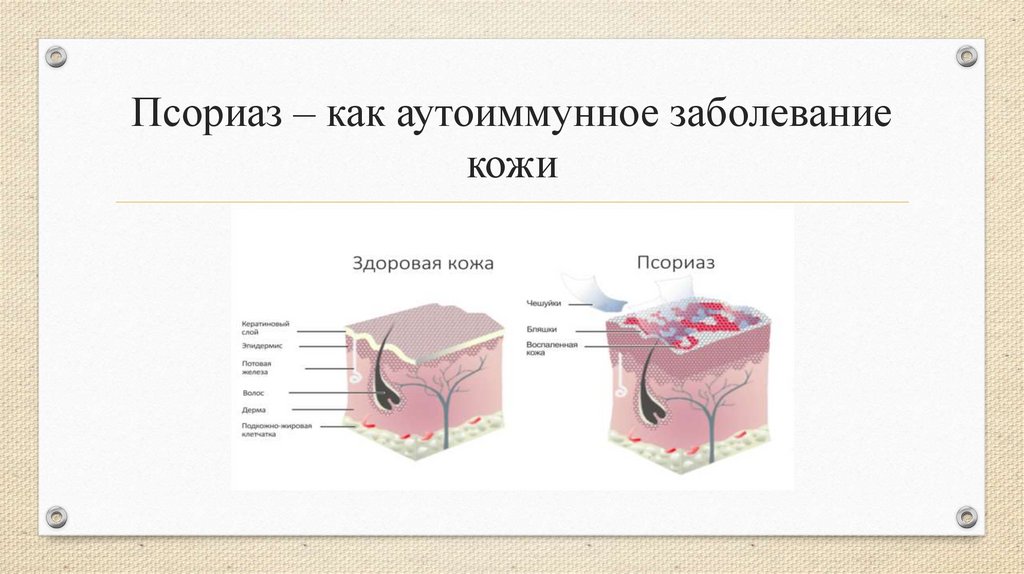 Lechenie Psoriaza V Domashnikh Usloviakh Prezentaciya Onlajn