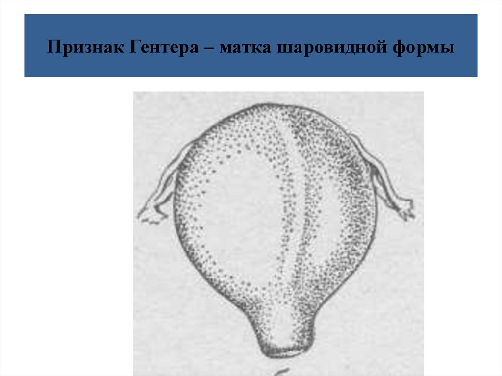 Какие матки бывают у женщины. Матка шаровидной формы при беременности. Шаровидная форма.