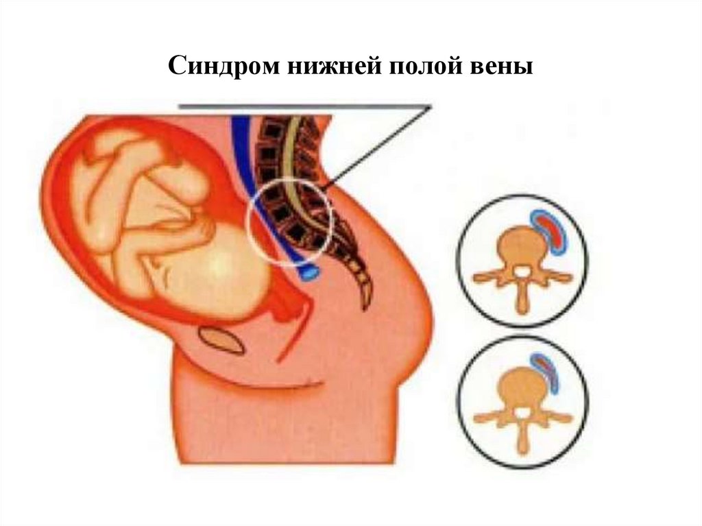 Синдром вен. Профилактика синдрома сдавления нижней полой вены. Варикозное расширение вен матки у беременных. При синдроме сдавления нижней полой вены. Сдавливание нижней полой вены при беременности.