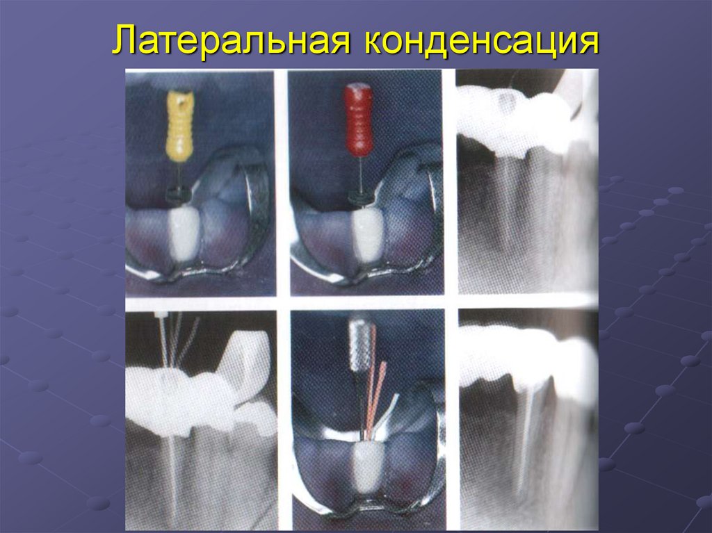 Пломбирование канала латеральной конденсацией. Латеральная конденсация гуттаперчи этапы. Метод латеральной конденсации. Метод латеральной конденсации с мастер штифтом. Пломбировка латеральной конденсацией.