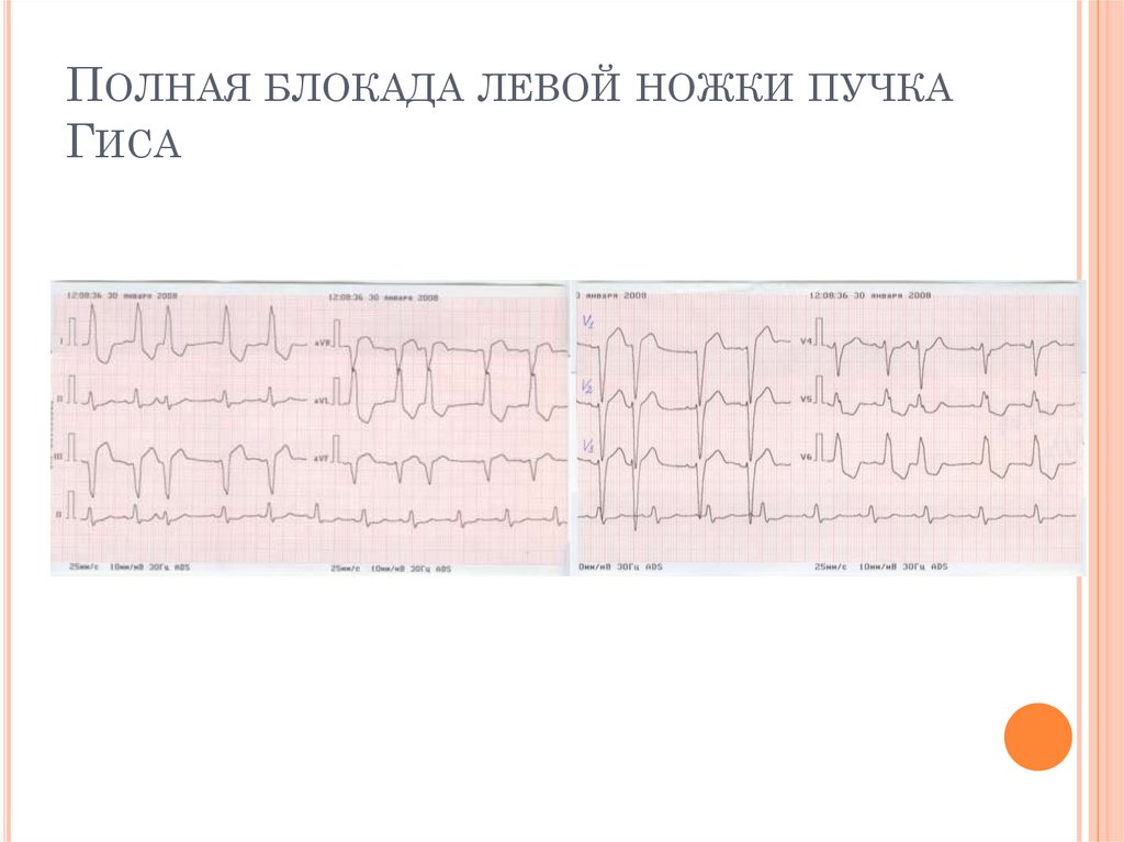 Экг блокада левой ножки пучка гиса фото