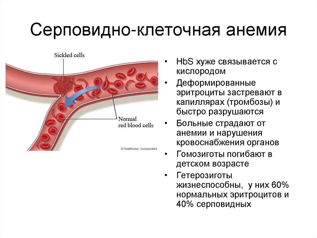 Ген серповидноклеточной анемии. При серповидно-клеточной анемии гемоглобин:. Серповидноклеточная анемия симптомы. Серповидноклеточная анемия картина крови. Серапиамно коеточная пнемия.