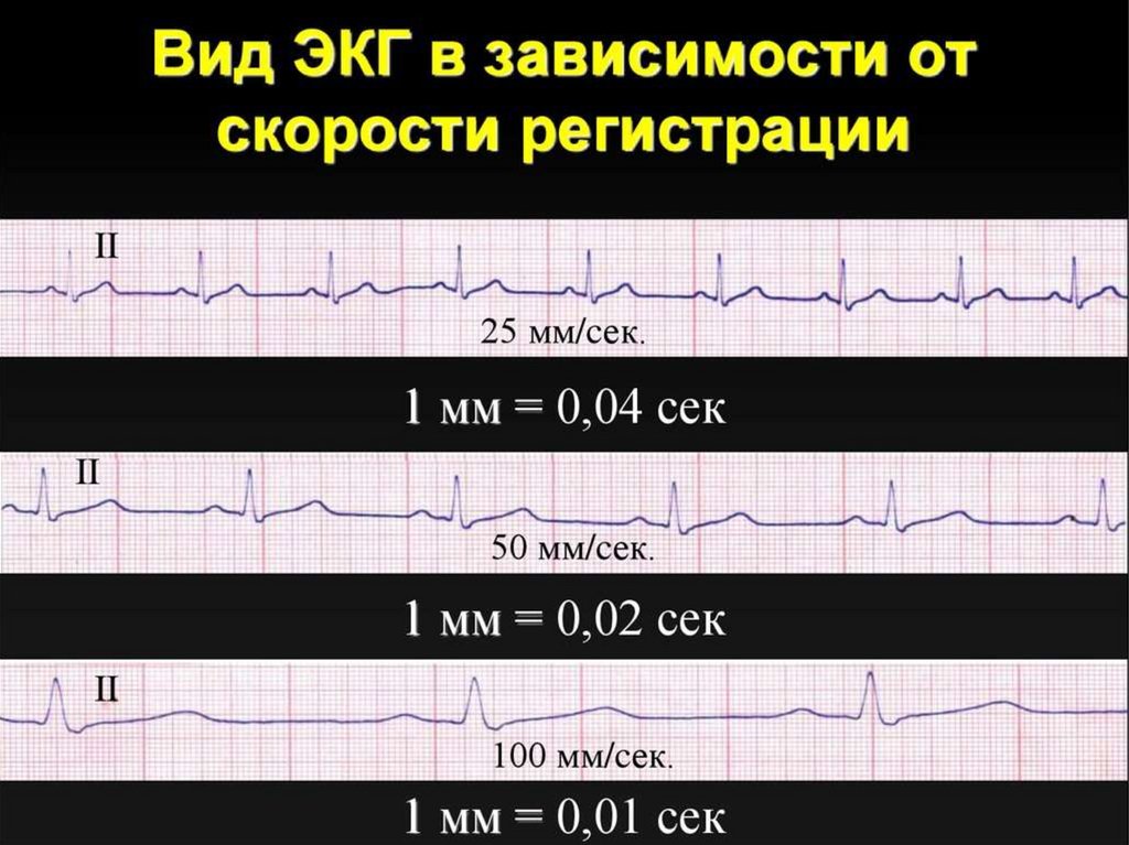 Презентация по экг